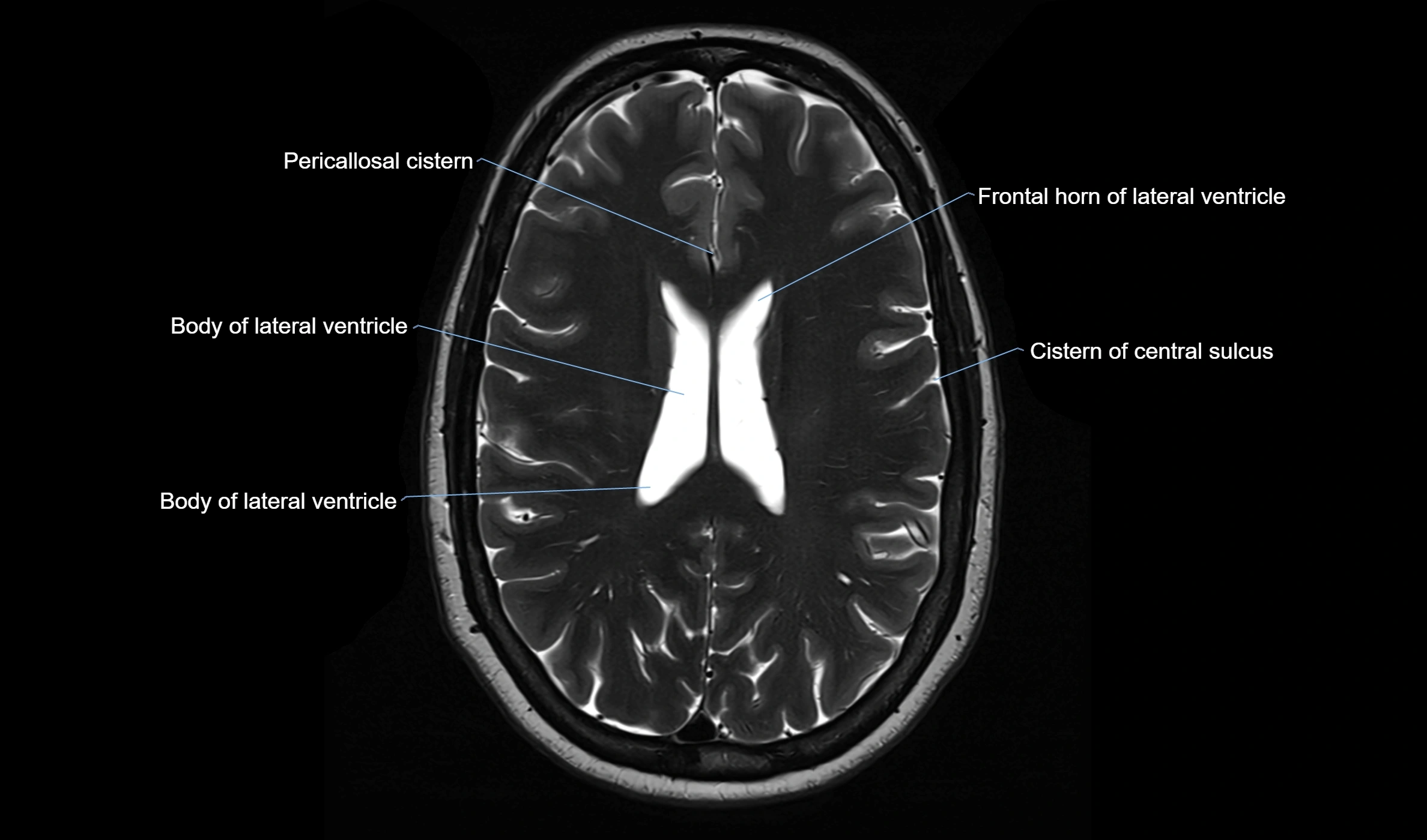 Brain cisterns  and ventricles  axial anatomy 3T MRI image-img-00001-00036.webp